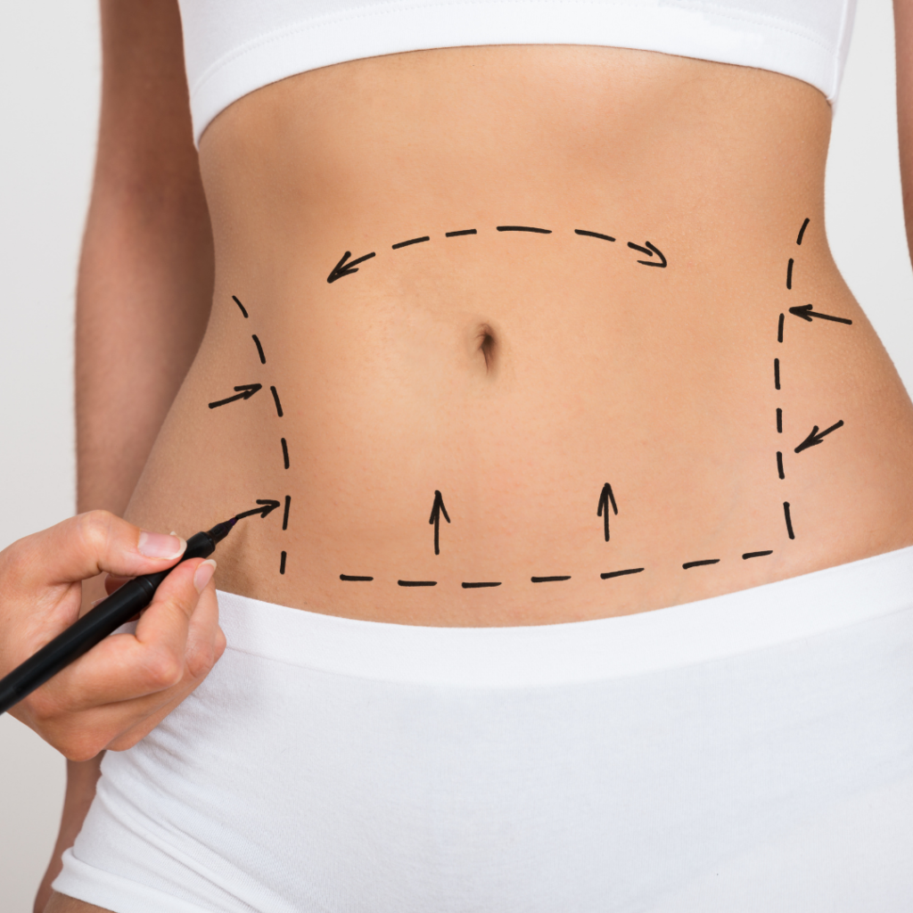 Laser Liposuction Long Island