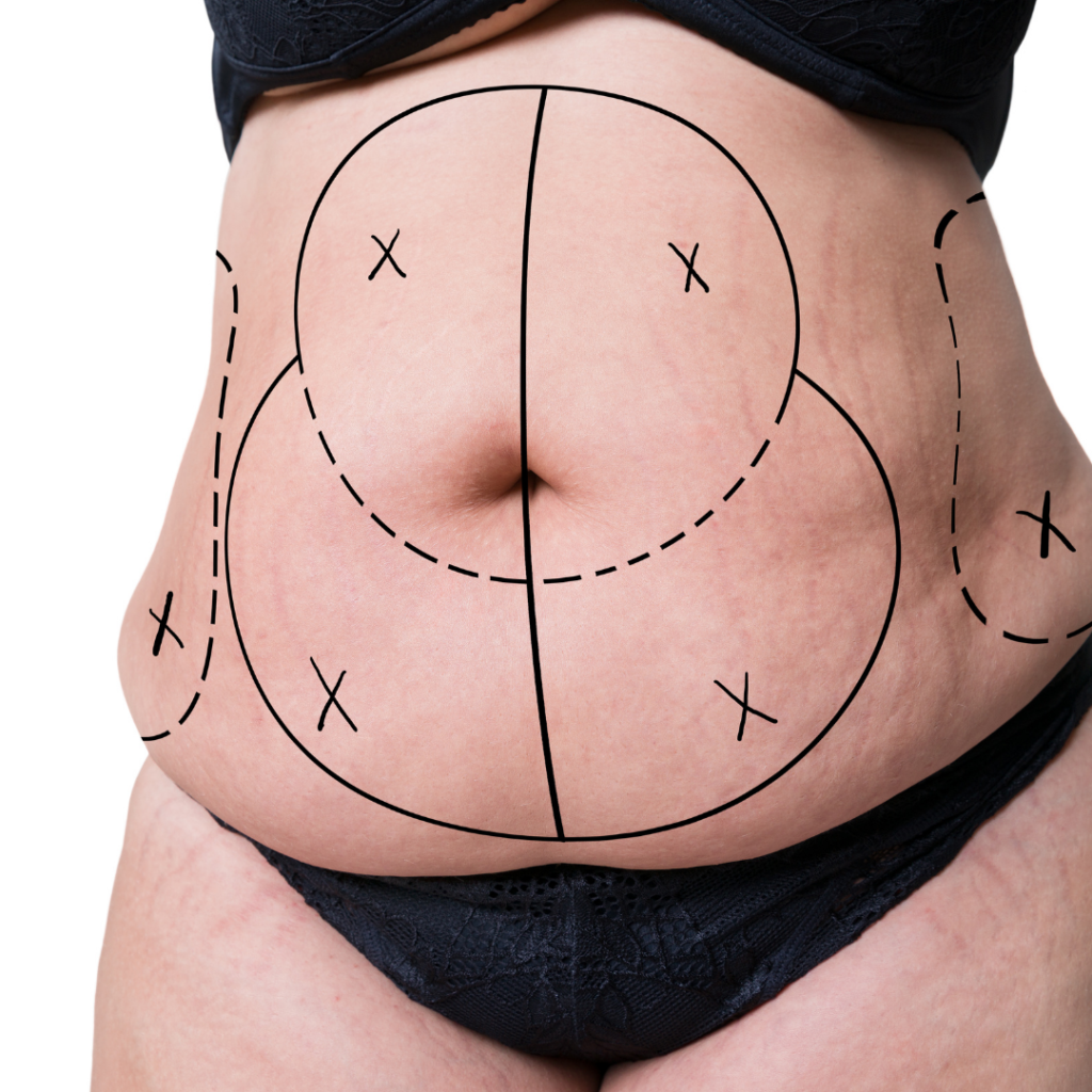 Laser Liposuction Long Island